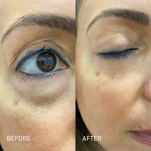 Allura™ Eye Spa Kit With Red Light Therapy