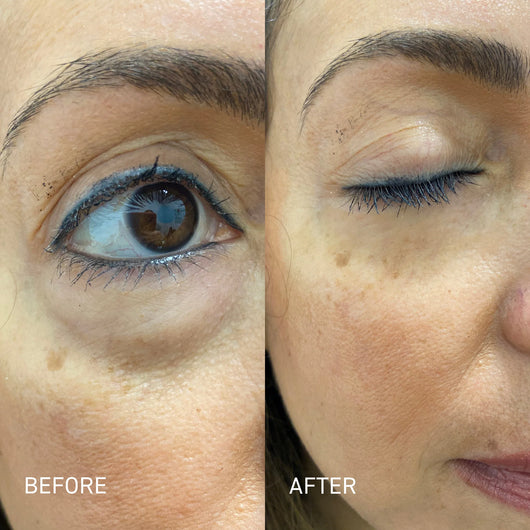 Allura™ Eye Spa Kit With Red Light Therapy